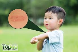 Does the fda regulate all hand sanitizers? Home Remedies To Treat Ringworm In Kids 9 Safe Ways Top 10 Home Remedies