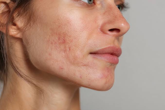 Laser Scar Removal At Vigour Aesthetics + Wellness | Vigour Aesthetics