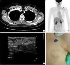 Sentinel lymph node mapping helps to identify the lymph nodes that are at highest risk for containing cancer. A 39 Year Old Female Patient With Breast Cancer Who Underwent Total Download Scientific Diagram