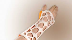 Russian Company Looks To Bring 3d Printed Casts To Market 3dprint Com The Voice Of 3d Printing Additive Manufacturing Heal Broken Bones Prints Broken Bone
