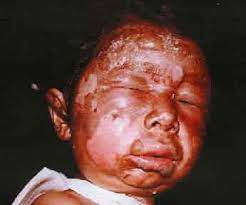 The Effects Of Mustard Gas A Changing Of Ethics From Bayonets To Drones