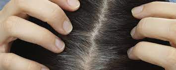 Essentially, hair that falls out (a natural occurrence) is not replaced like it normally would be. Excess Sebum Hair Loss We Know The Answer Viviscal Healthy Hair Tips