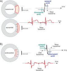 Image result for ST Elevation