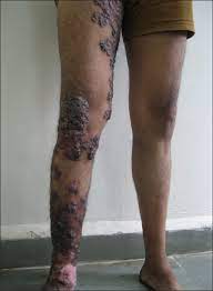 A 68‐year‐old peasant had an 8‐year history of tuberculosis verrucosa cutis. A Case Of Extensive Multifocal Tuberculosis Verrucosa Cutis Verma R Vasudevan B Pragasam V Badad A Indian J Dermatol