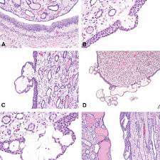 Papillary adenomas of the kidney are benign renal neoplasms arising from the renal tubular epithelium and almost always located within the cortex. A Renal Papilla Top With Single Cell Layer Lining Epithelium Download Scientific Diagram