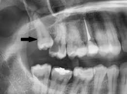 Wenn man sagt, der weisheitszahn kommt raus oder die weisheitszähne kommen, meint man, ein weisheitszahn bricht durch das zahnfleisch in die mundhöhle (weisheitszahndurchbruch), wenn er weit genug gewachsen ist. Weisheitszahnentfernung Dr Michael Korsch