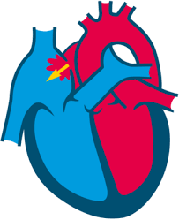 Image result for Atrial Septal Defect