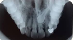 Check spelling or type a new query. Evaluation Of Radiographic Techniques For Localization Of Impacted Maxillary Canines Springerlink