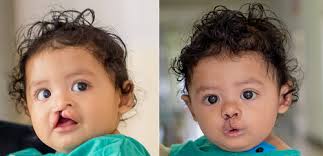 The absence of disability weights for untreated cleft lip and palate. Cleft Lip Nose Repair Up Pediatric Plastic Surgery