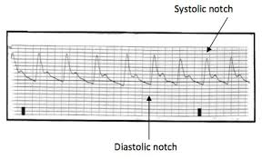 Arterial Blood And Ventral Venous Pressure Monitoring