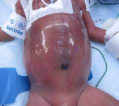 Neonatal Short Bowel Syndrome American Academy Of Pediatrics
