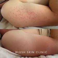 Image result for Keratosis pilaris