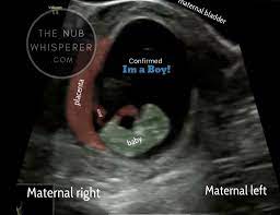 Gender Prediction Ramzi Theory Ultrasound Gender Gender Prediction Ramzi Theory