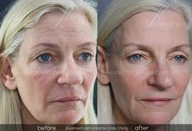 The fillers are either injected to lift the cheeks and/or the skin around the jawline. The Liquid Lift Facelove