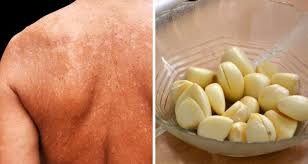 Ada beberapa cara untuk menghilangkan panu di muka tersebut. Hilangkan Panau Badan Yang Semakin Membiak Inilah Cara Mudah Dan Murah Pesona Pengantin
