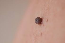 Como Eliminar Verrugas Y Lunares Con Plasma Pen De Forma Segura Eternia Derma Center