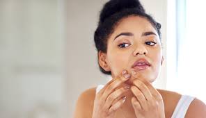 Clients Ask: Can Face Masks Cause Acne?