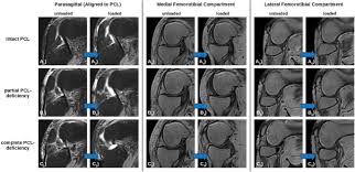 Image result for PCL Sulcus Test