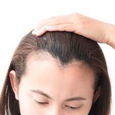 The right hairstyle for a receding hairline on women is having a full bang or keeping the hair right around the temples heavy and long. How To Stop And Regrow A Receding Hairline Best Treatments Allure