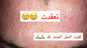 تجربتي مع حب الشباب حبوب تحت الجلد شاركت معاكم صور ديال الحبوب لي كان فيا الحل النهائي للحبوب Youtube