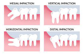 Local anaesthesia is injected before a wisdom tooth is extracted. Wisdom Tooth Extraction Removal In Bangkok Thailand