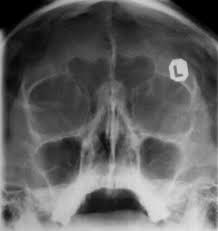 Image result for Sinus X Ray