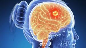 Check spelling or type a new query. 6 Gejala Tumor Otak Stadium Awal Yang Perlu Diwaspadai Health Liputan6 Com