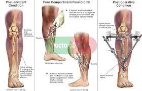 Leg Injury Tibial Fractures With Four Compartment Fasciotomy Surgery Fractures Complications Of Fractures Leg Injury