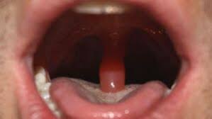 Image result for Uvulitis