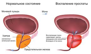 Prostatit Otkrovennyj Muzhskoj Razgovor Stati Medi