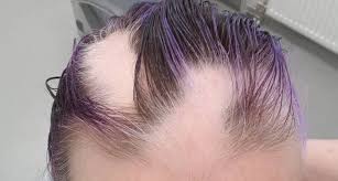 Alopecia areata is an autoimmune disorder that usually results in unpredictable, patchy hair loss. Alopecia Areata Immer Noch Da Ich Trotzdem Happy Storfine