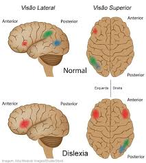 Whether you're a parent or teacher— or think you might have dyslexia yourself—here's what to look for, starting in the earliest years through adulthood. Pin On Dislexia