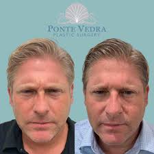 Before and After: Botox...