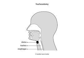 Image result for Tracheostomy