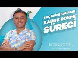 Ibrahim Cevik Anlatti Sac Ekimi Sonrasi Kabuk Dokme Sureci Youtube Sac Youtube Ekim