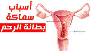 ماهي اسباب واعراض سماكة وتضخم بطانة الرحم وطرق علاجها youtube