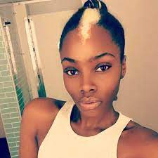 Woman With Piebaldism Becomes A Model And Proves Her Haters Wrong White Streak In Hair White Skin Patches White Hair Birthmark