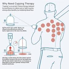 24 cup vacuum hijama cupping set