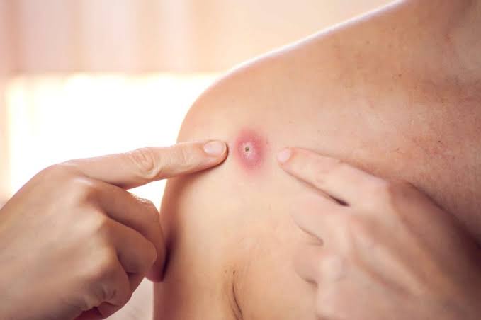 Skin Lump Evaluation & Treatment in Singapore | Alpine Surgical