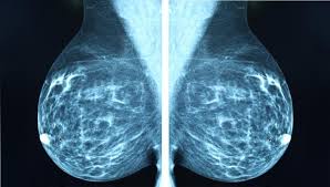 A ct scan is better suited to cancer. Skipping Mammogram Increases Risk Of Death From Breast Cancer Imaging Technology News