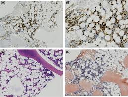 Cambodia cameroon cape verde cayman islands central african republic chad chile china christmas island cocos (keeling) islands colombia comoros congo congo, the. Light Chain Lambda Myeloma With Fatal Al Cardiac Amyloidosis In A 21 Year Old Patient A Case Report And Review Camus 2019 Clinical Case Reports Wiley Online Library