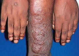 Check spelling or type a new query. Cutaneous Manifestation In Thyroid Disorders Epomedicine