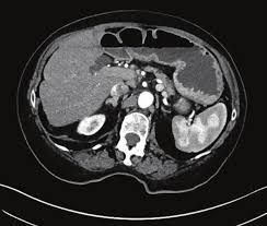 Image result for Succussion Splash