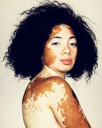 Brock Elbank Mrelbank Fotos Y Videos De Instagram Vitiligo Model Vitiligo Beautiful Skin