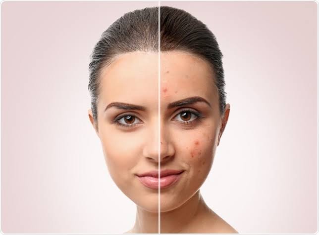 Clear skin after laser acne treatment at Profrea