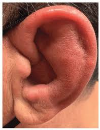 External Ear: Perichondritis, Lacerations, Auricular Hematoma | Ento Key