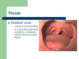Why Is My Uvula Deviated To The Right Quora