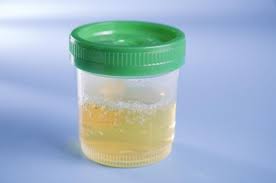Sementara itu, ketika kencing berbusa ternyata disebabkan oleh ejakulasi mundur, dokter bisa saja memberikan resep obat yang cocok. Benarkah Warna Urine Bisa Menunjukkan Jenis Kelamin Anak Di Rahim