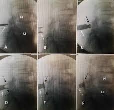 Cureus The Use Of Vertiflex Interspinous Spacer Device In