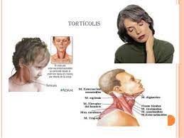 We did not find results for: Torticolis